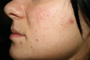 Покалывание кожи, сыпь на одной стороне лица или тела